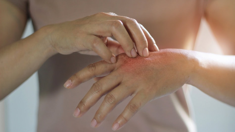 La dermatitis es la inflamación de las capas superficiales de la piel