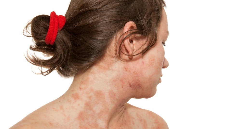 La dermatitis es una afección cutánea muy frecuente